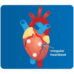 cardiac arrest